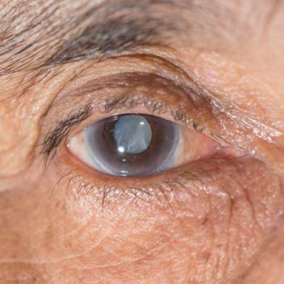 Eye Damage, cataracts, from not using eye protection